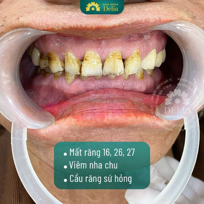 Sâu răng cửa phải làm sao? Cách điều trị răng cửa bị sâu tốt nhất