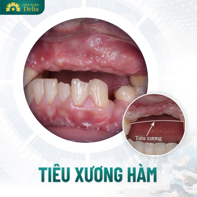 Tiêu xương hàm có niềng răng được không? Yếu tố quan trọng nhất