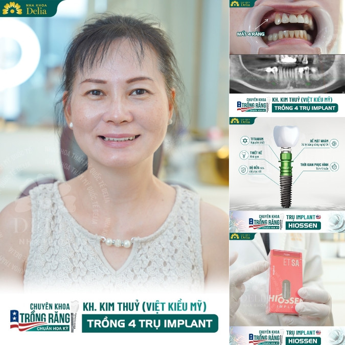 Triệu chứng sau cấy Implant thường gặp là gì? Dấu hiệu bất thường