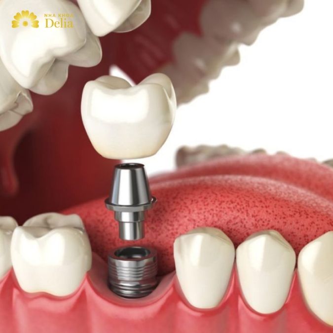 Có trồng răng cấm được không? Phương pháp nào hiệu quả nhất?