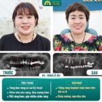 Cách tối ưu chi phí khi trồng răng Implant