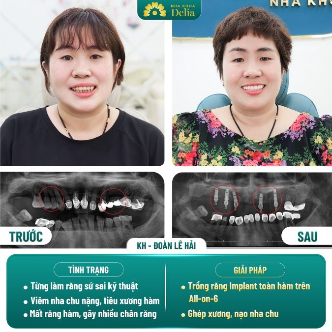 Trồng răng Implant có được bảo hiểm không?