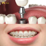 Trồng răng Implant có niềng răng được không
