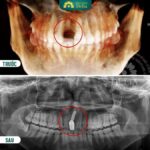 trồng răng Implant được bao lâu