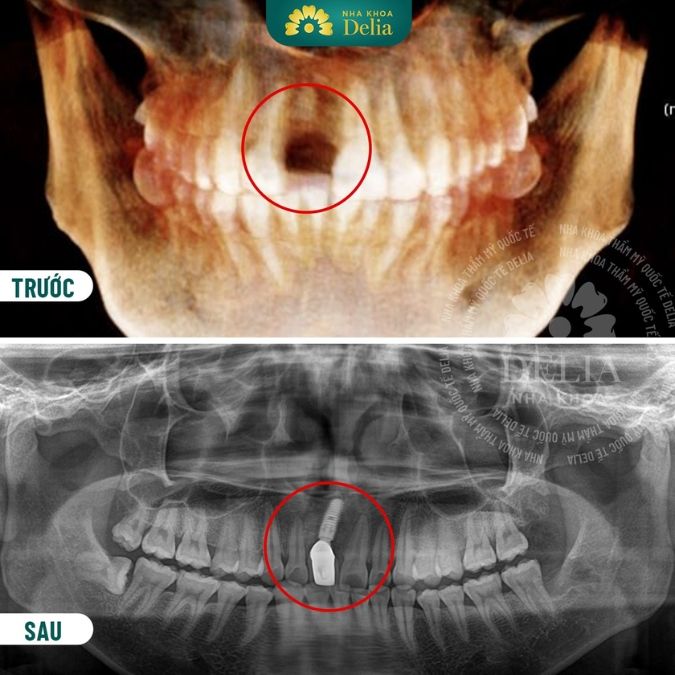 Trồng răng Implant được bao lâu? Có dùng được trọn đời?
