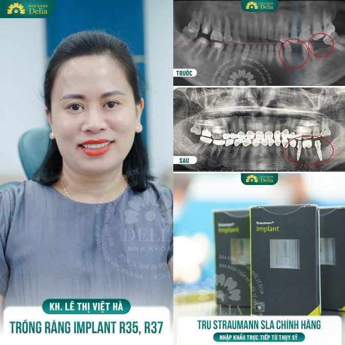 Trồng răng Implant trả góp – Có nên hay không?
