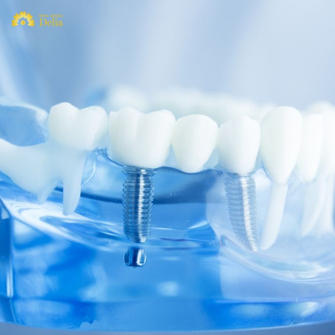 Công nghệ 3D Implant có vai trò gì trong cấy ghép răng? Ưu điểm của trồng Implant 3D