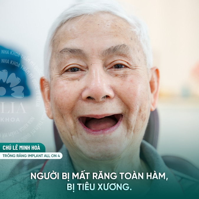 Tư vấn: 60 tuổi có trồng Implant được không?