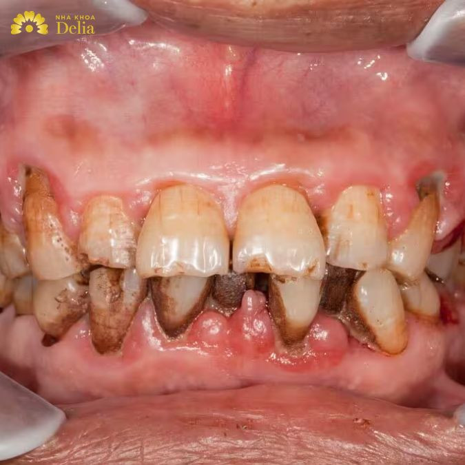 Cao răng đen là gì? Cách trị cao răng đen tại nhà và nha khoa