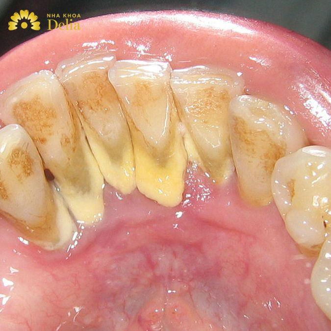 Cao răng nhiều phải làm sao? Giải pháp khắc phục hiệu quả nhất