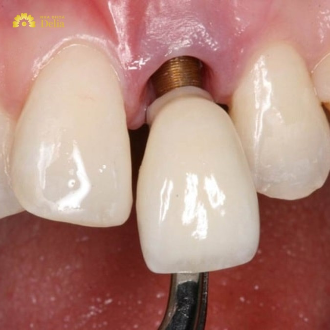 Dấu hiệu trụ Implant bị đào thải? Nguyên nhân do đâu?