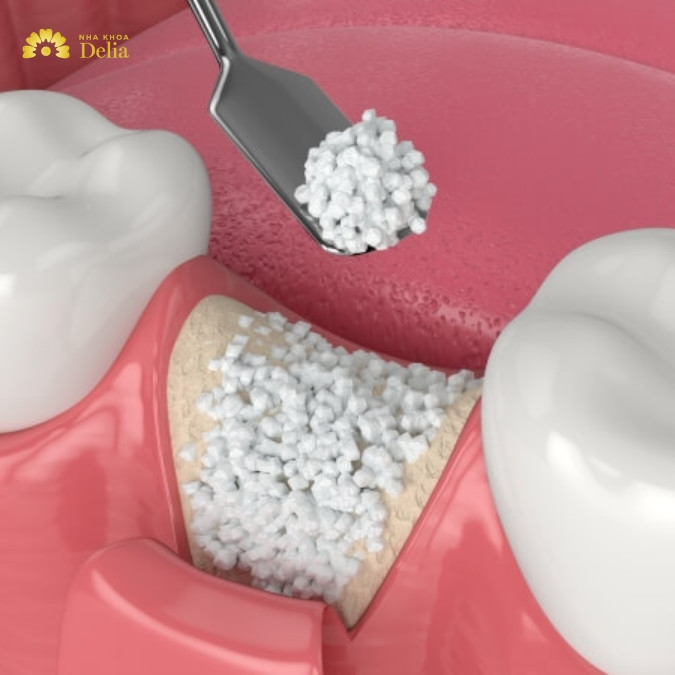 Ghép xương răng là gì? Trồng Implant có bắt buộc ghép xương răng không?