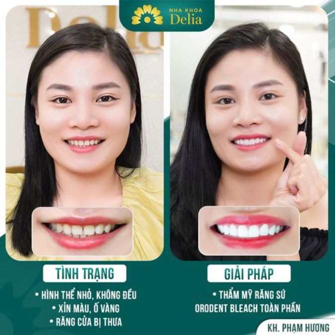 Phạm Hương Review quá trình cải thiện HỞ RĂNG CỬA chỉ 2 ngày