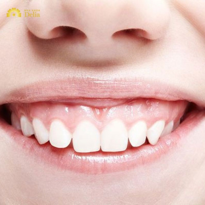 Hô xương ổ răng là gì? Hô xương ổ răng và hô hàm có giống nhau không?