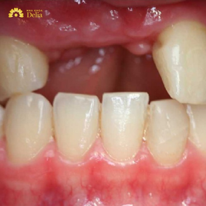 Mất 2 răng cửa phải làm sao? Không trồng lại có sao không?