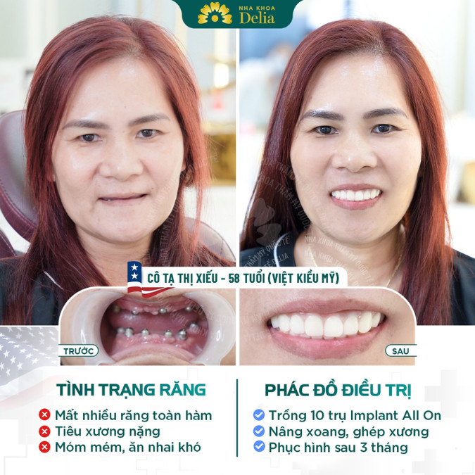 Mất 3 răng hàm dưới có nên trồng Implant không?