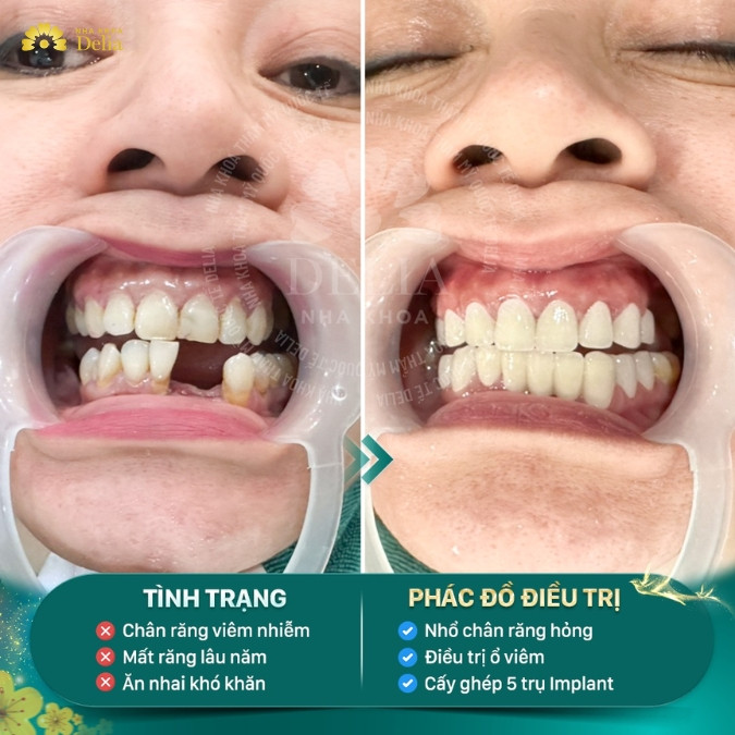Mất răng không trồng lại có sao không? Hậu quả mất răng