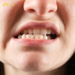 Mất răng có bị lệch mặt không