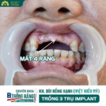 Mất răng cửa
