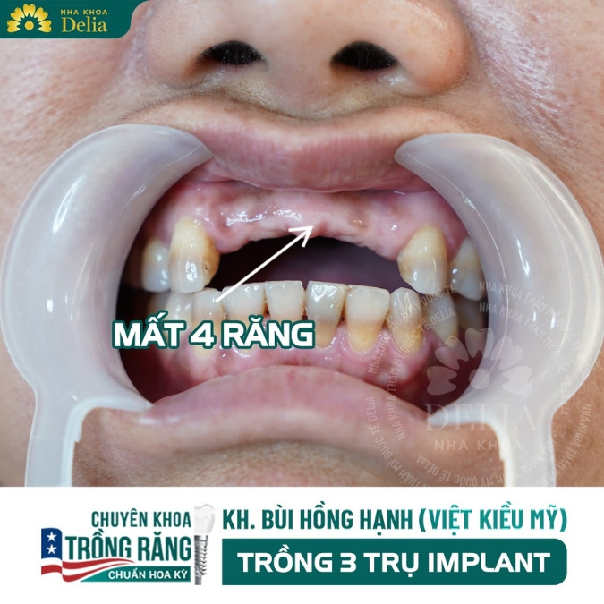 Mất răng cửa và hành trình khôi phục nụ cười của chị Lisa Bùi