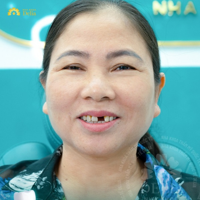 Mất răng số 2 có sao không? Phương pháp khắc phục mất răng số 2 tốt nhất hiện nay?