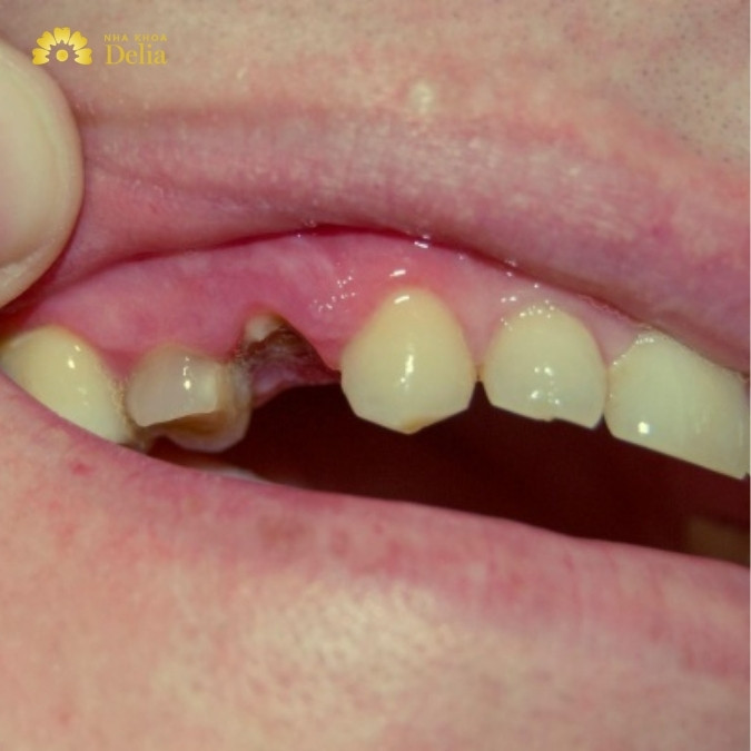 Mất răng số 4 có sao không? Có nên làm cầu răng sứ khi bị mất răng số 4?