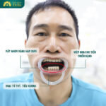 Mất răng số 6