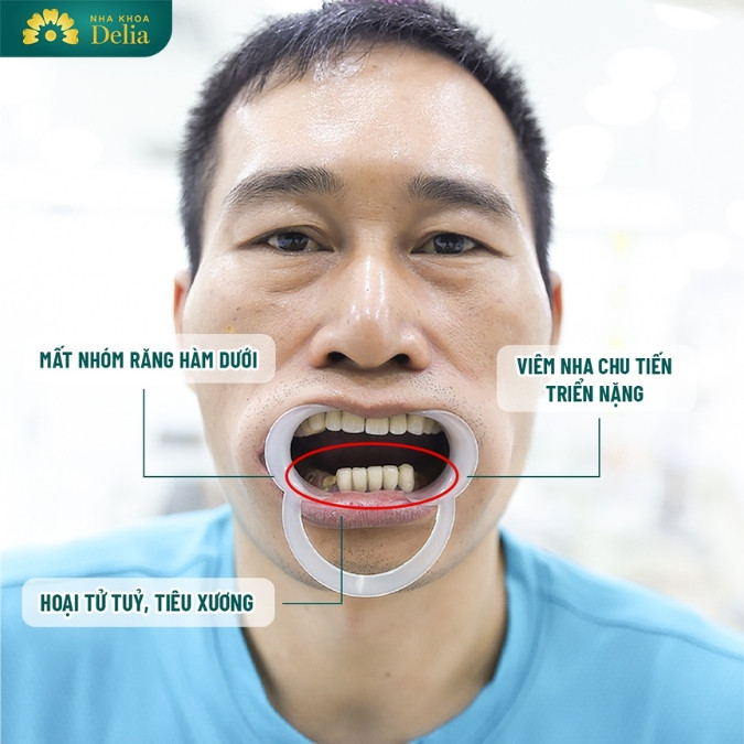 Mất răng số 6 có mọc lại được không? Phương pháp phục hồi răng số 6 hiệu quả?