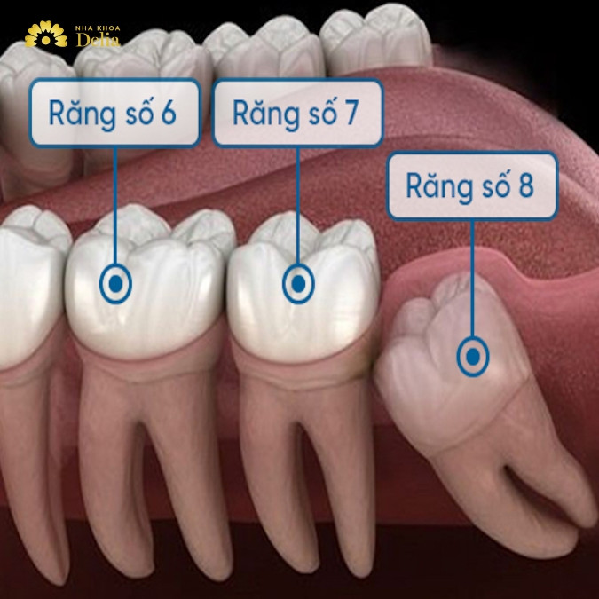 Tại sao mất răng số 7 phải trồng Implant mới hiệu quả? Biến chứng mất răng