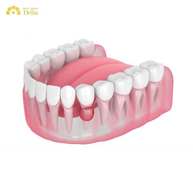 Nang xương răng là gì? Nang xương hàm do răng có dễ nhận biết?