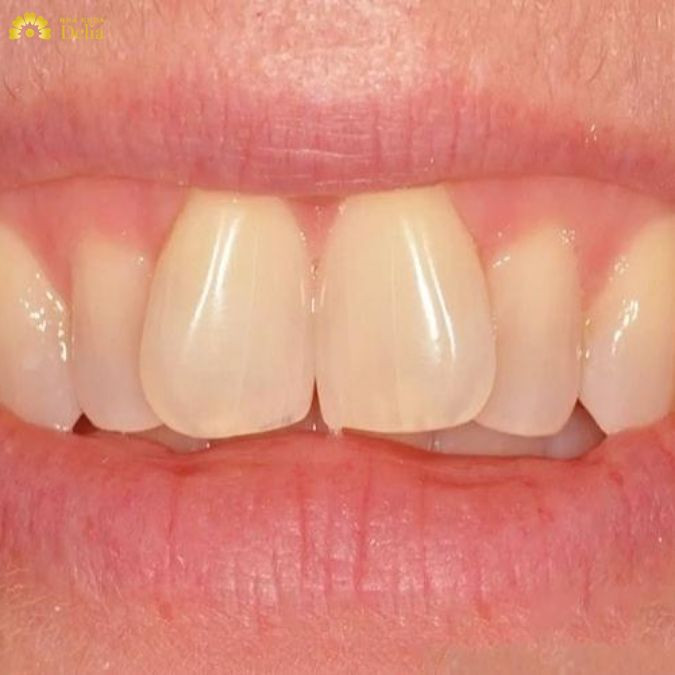 Răng cánh bướm đẹp hay xấu? Cải thiện răng cửa chữ V như nào?
