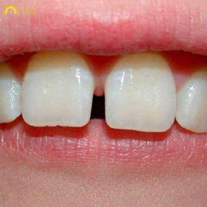 Răng cửa dài tướng số | Cải thiện hậu vận răng cửa dài hơn răng khác