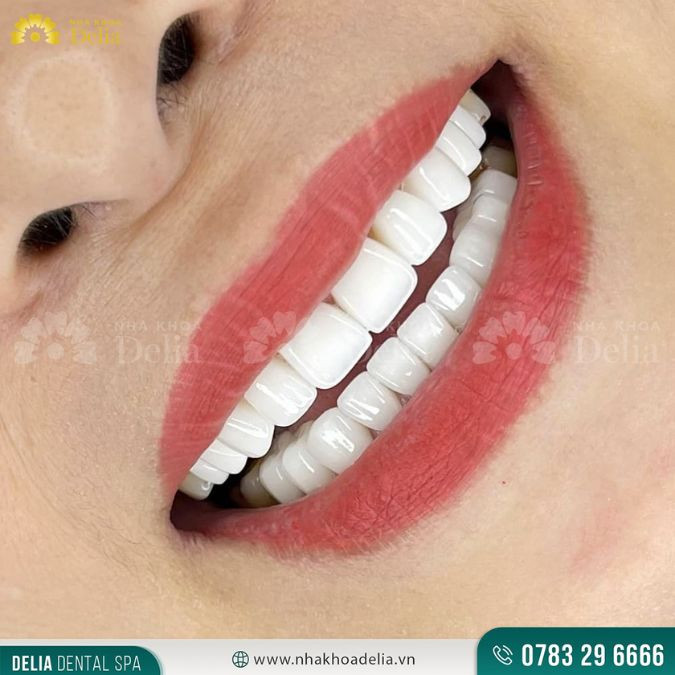 Khắc phục răng cửa mọc nhọn bằng cách nào? Dễ hay khó?