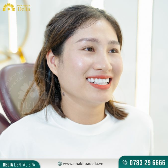 Khắc phục răng cửa không đều chỉ trong 2 ngày