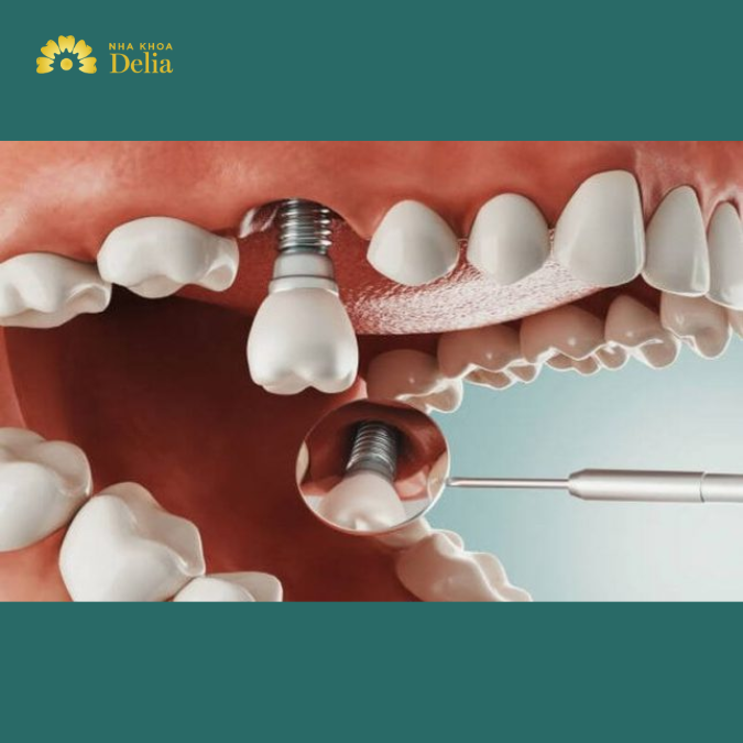 Tư vấn: Sâu răng có nên trồng Implant không?