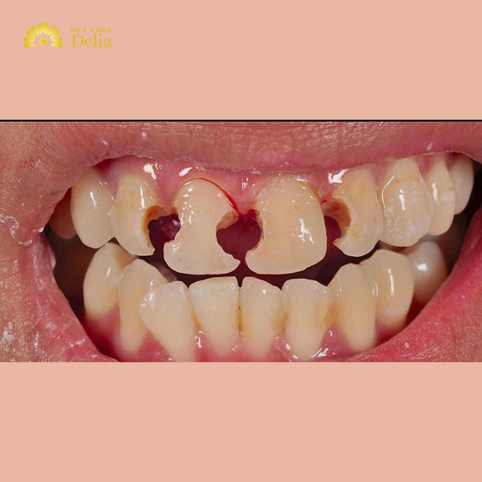 Sâu răng cửa: Nguyên nhân, ảnh hưởng và cách điều trị