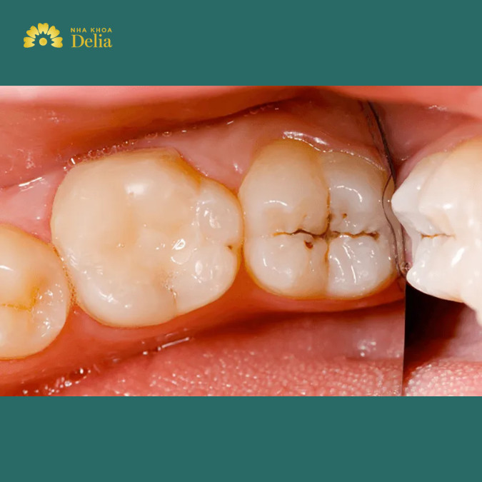 Sâu răng nhẹ làm sao để khỏi dứt điểm, không lây sang răng khác