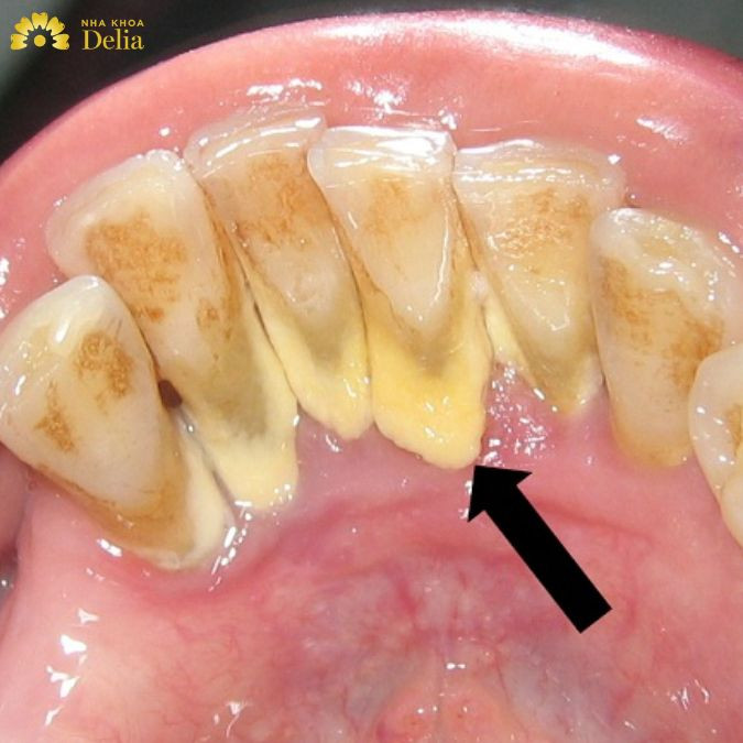 Tác hại của việc lấy cao răng sai cách: Nhiễm trùng, mòn men,..