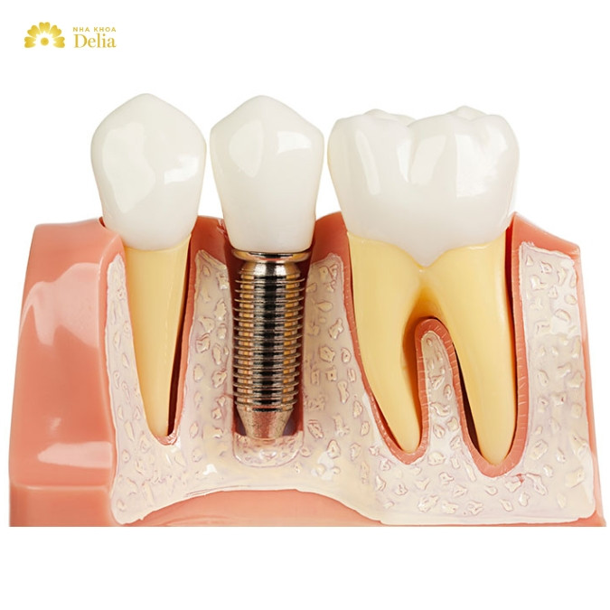 Trụ Implant bị lung lay có phải là một dấu hiệu nghiêm trọng?