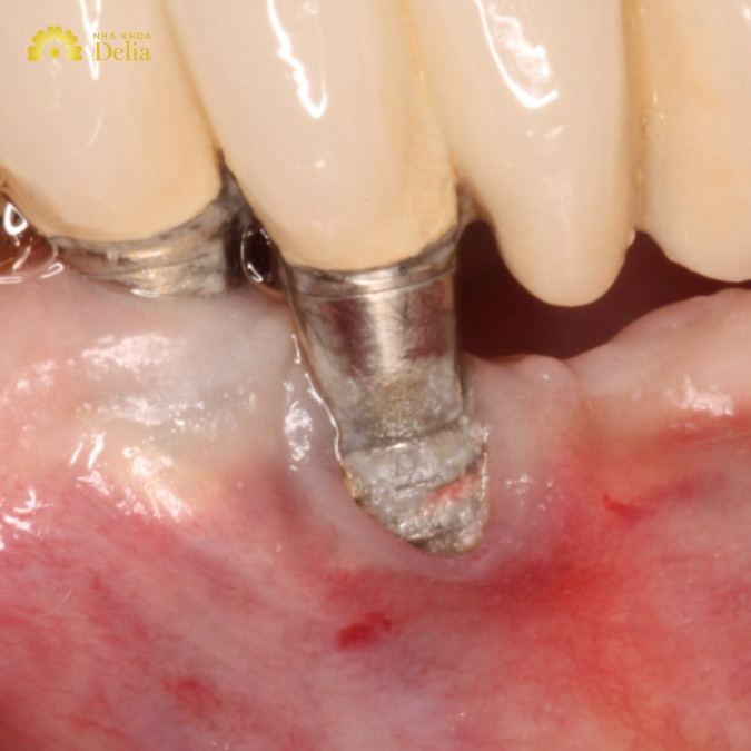 Trụ Implant Meditech có tốt không? Có nên sử dụng để cấy ghép răng?