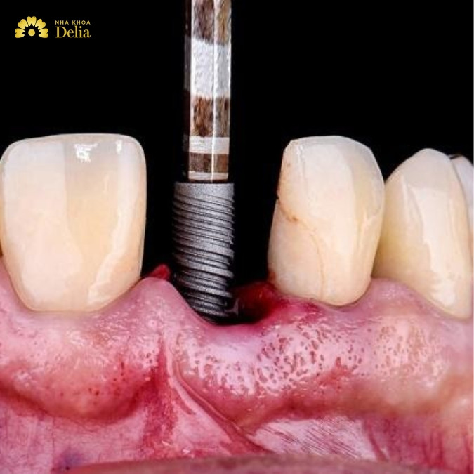 Trụ implant Otex của nước nào? Trụ Implant Otex giá bao nhiêu?