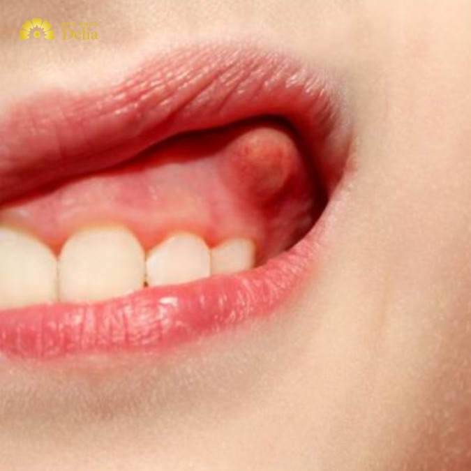 U xương răng là gì? U xương hàm răng có phải là tình trạng nguy hiểm?