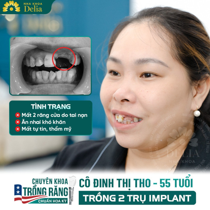 Giải đáp: Vỡ răng cửa có trồng được Implant không?