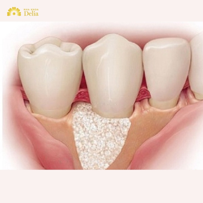 Xương ổ răng là gì? Cấu tạo xương ổ răng