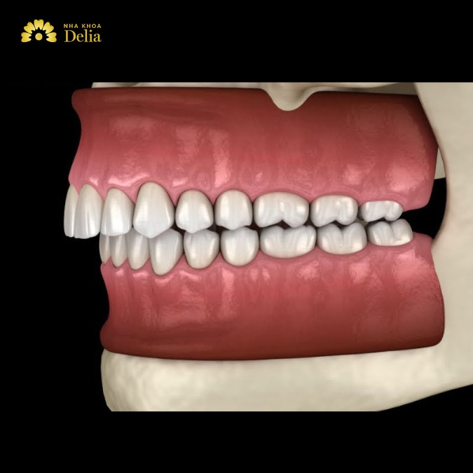Xương ổ răng quá dày có sao không? Mài xương ổ răng là gì?