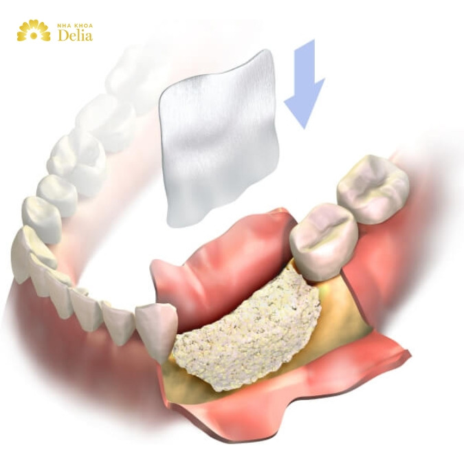 Xương răng mỏng là gì? Xương ổ răng mỏng có trồng răng được không?