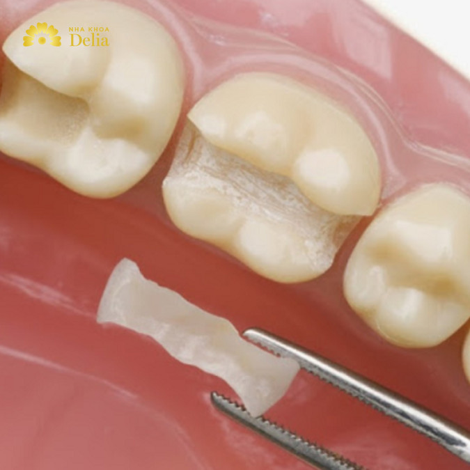 Miếng trám răng bị rớt phải làm sao, có trám lại được không?