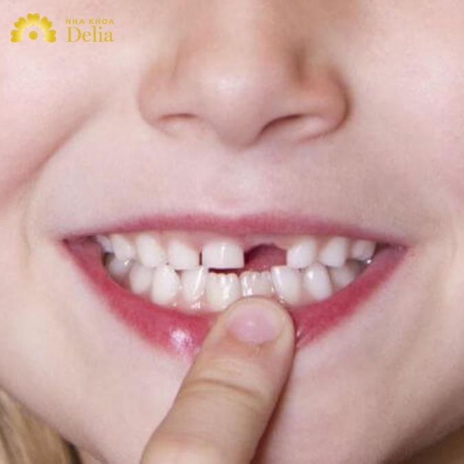Nằm mơ thấy răng rụng là điềm gì? Tốt hay xấu? May hay rủi?