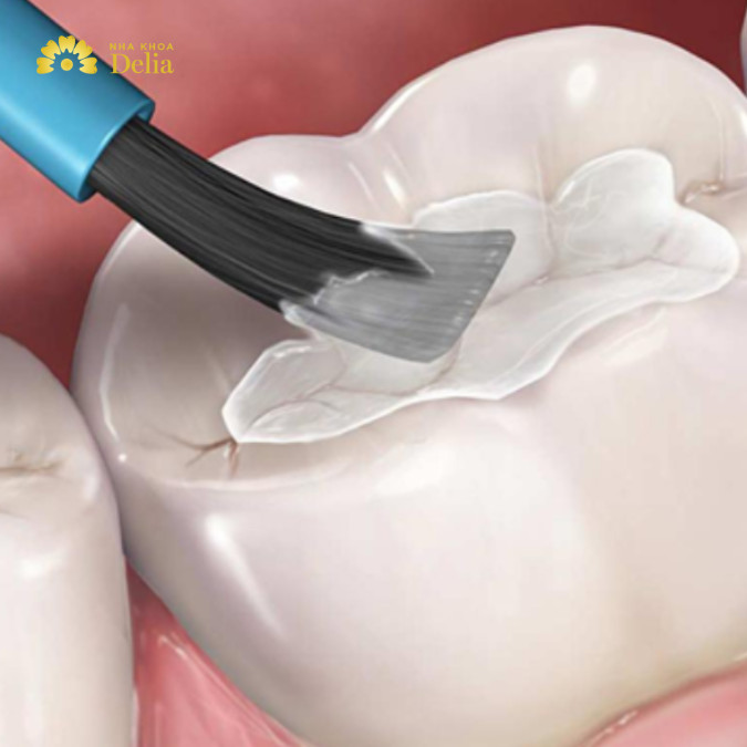 Quy trình trám răng chuẩn nha khoa, trám răng mất bao lâu?