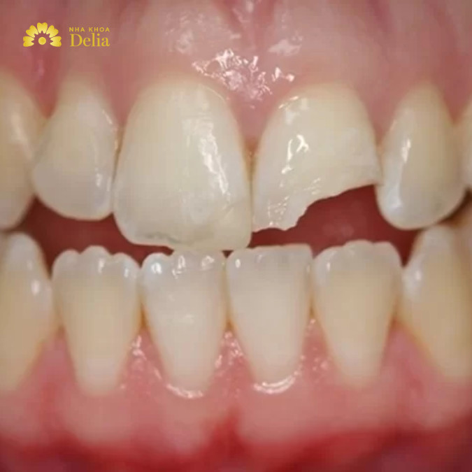 Răng bị vỡ có hàn được không, hàn hết bao nhiêu tiền?